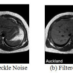 Fig2. (a)Speckle Noise (b) Filtered image