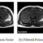 Fig8. (a)Poisson Noise (b) Filtered Poisson MRI image