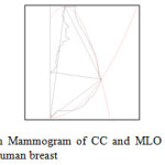 Figure12: Experimental result on Mammogram of CC and MLO views along with the final 3D structure for representation of human breast