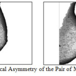 Figure14: Anatomical Asymmetry of the Pair of Mammogram image