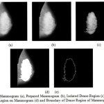 Figure15: Mammogram (a), Prepared Mammogram (b), Isolated Dense Region (c), Masked Dense Region on Mammogram (d) and Boundary of Dense Region of Mammogram (e)