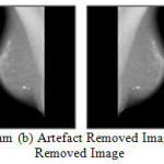 Figure 4(a) Original Mammogram (b) Artefact Removed Image (c) Flipped Image (d) Noise Removed Image
